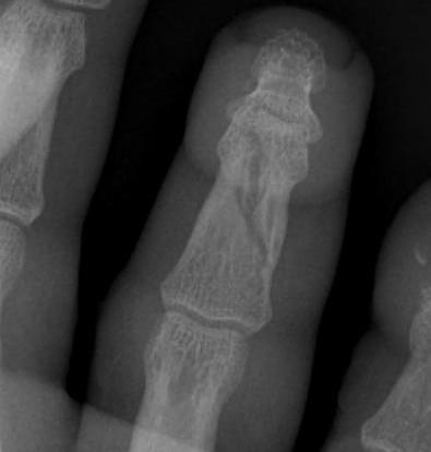 Finger Fracture Undisplaced